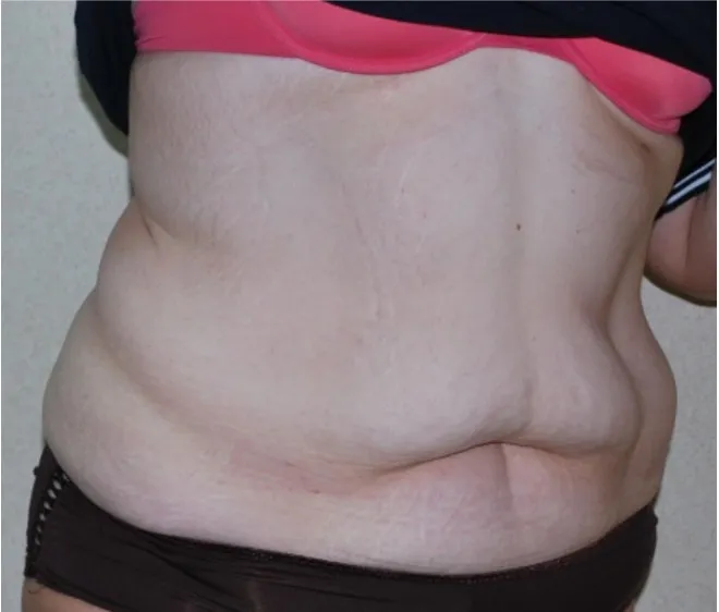 Before tummy tuck in Dubai, patient 8