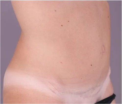 After tummy tuck in Dubai, patient 9