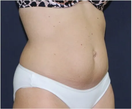 Before tummy tuck in Dubai, patient 9
