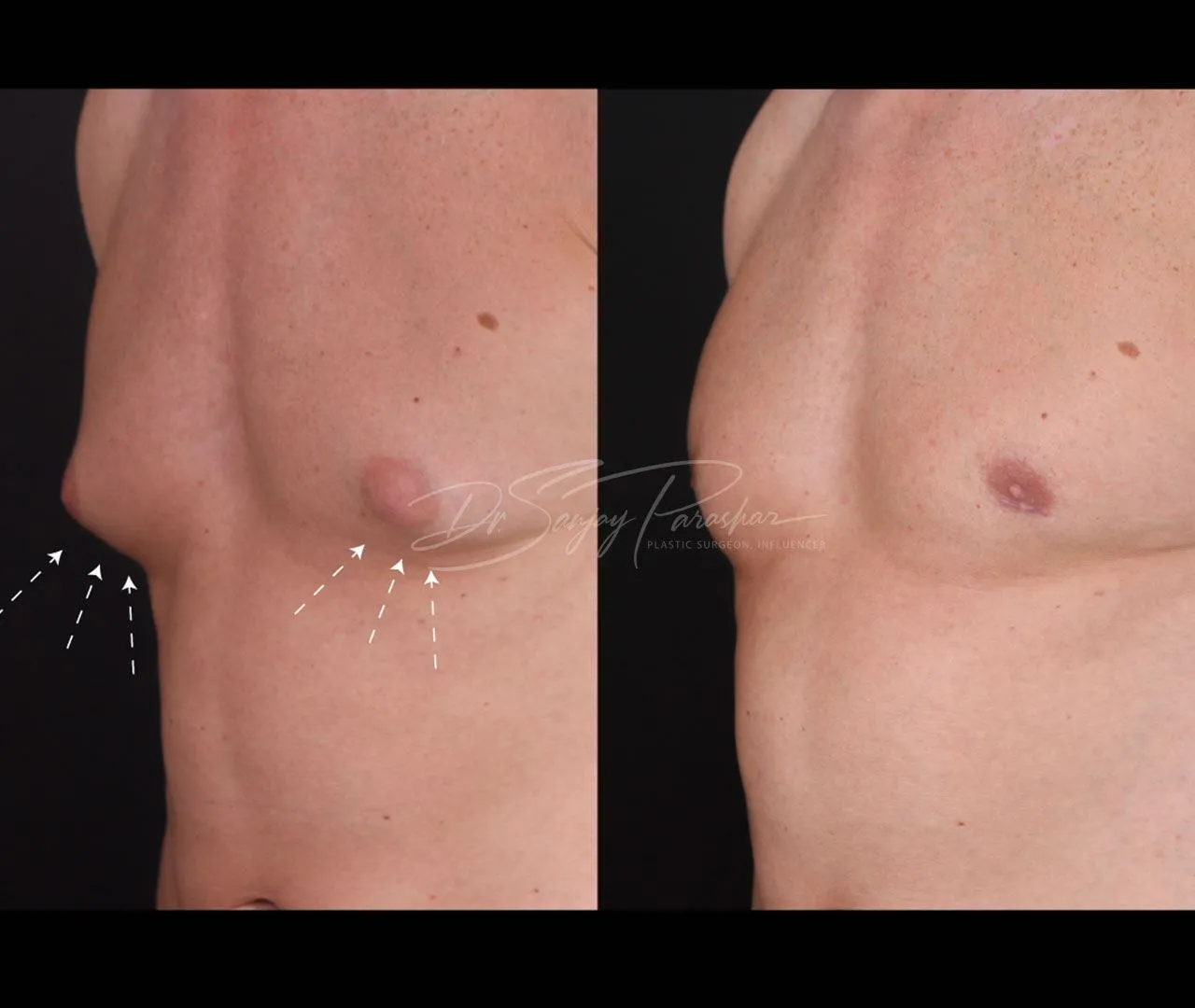 Before and after gynecomastia surgery in Dubai, result 1