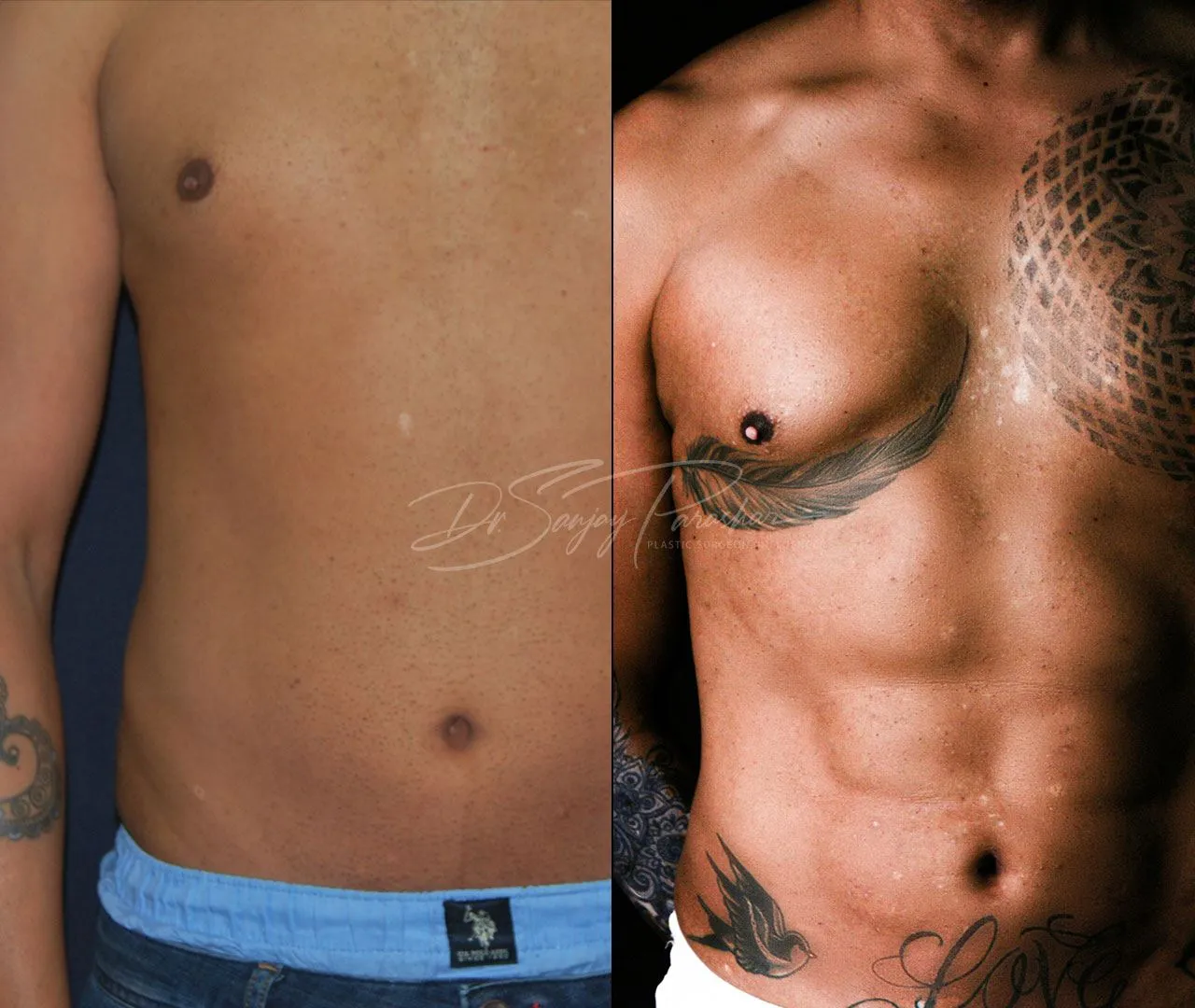 Before and after sixpack liposuction in Dubai, result 1