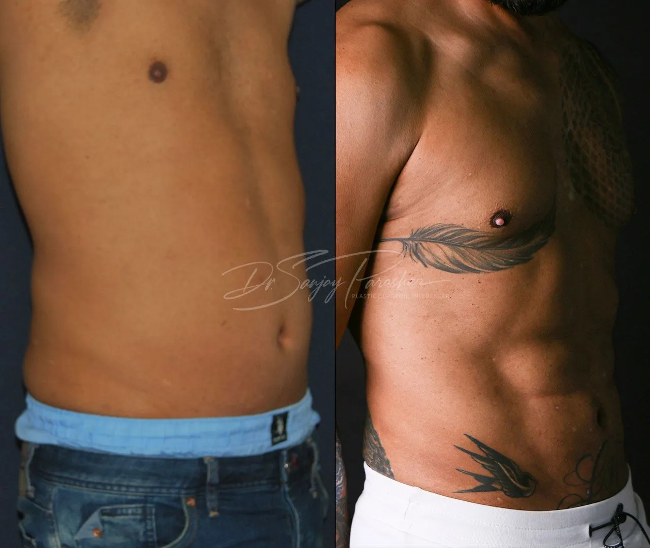Before and after sixpack liposuction in Dubai, result 2
