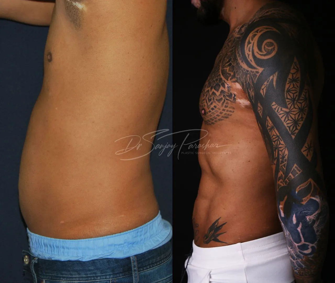 Before and after sixpack liposuction in Dubai, result 3