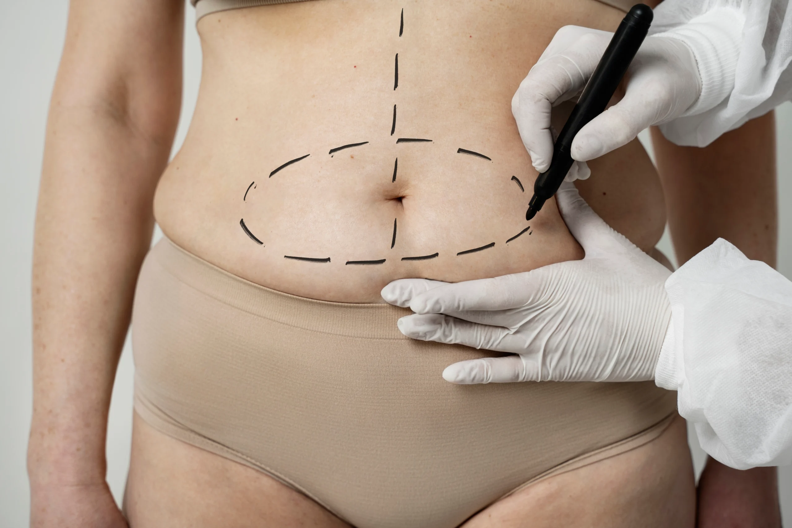 Mini Tummy Tuck vs Full Tummy Tuck: Which One Do You Need?