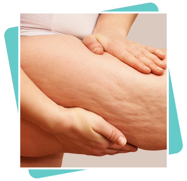 Best Thigh Liposuction Surgeon In Dubai