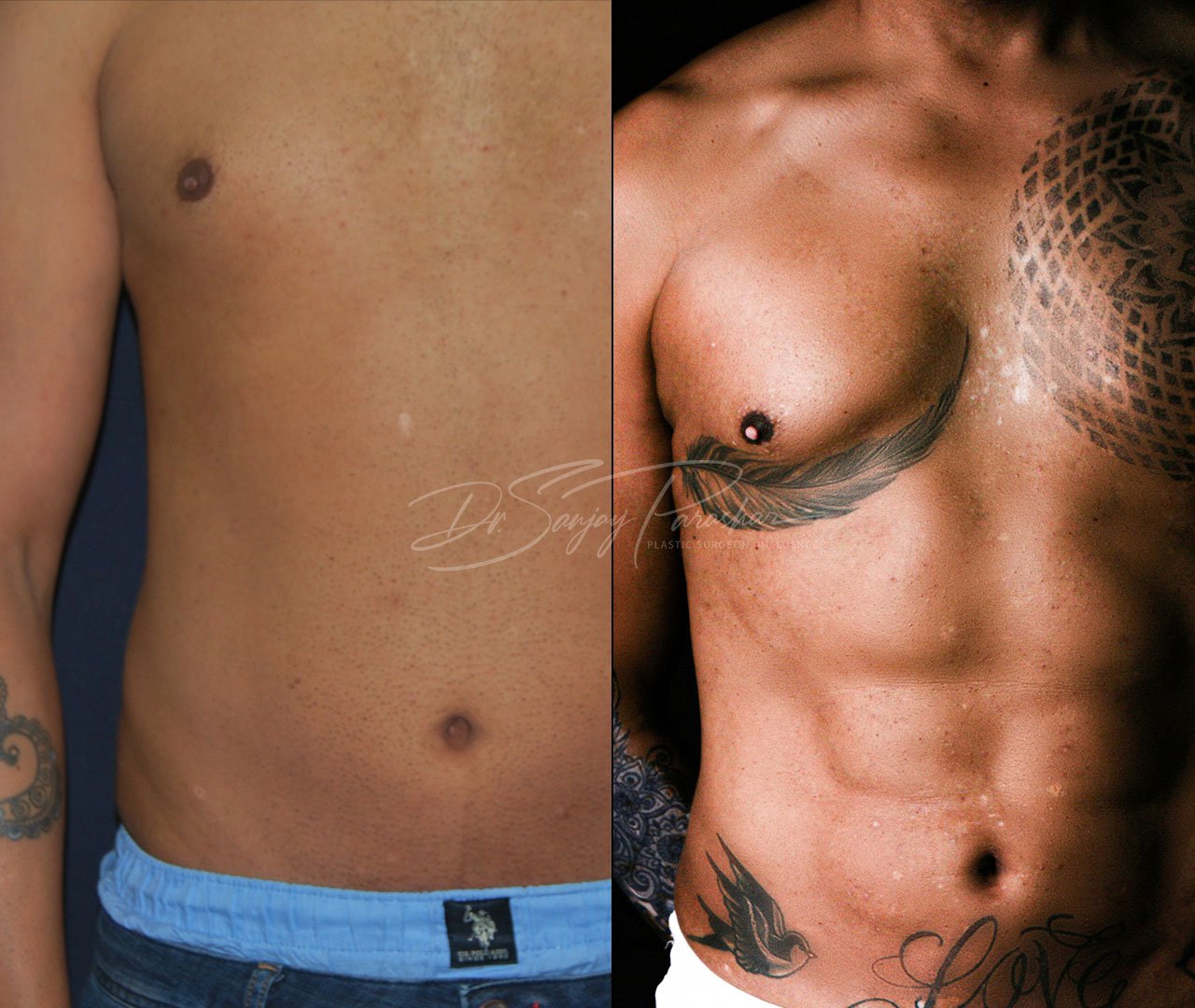 Patient Result For Sixpack Liposuction In Dubai