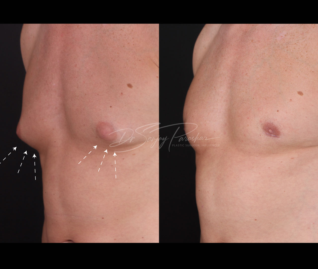 Gynecomastia Surgery In Dubai