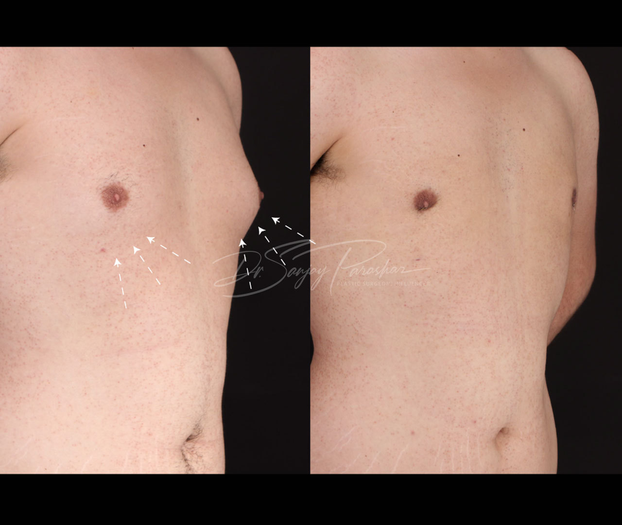 Gynecomastia Surgery In Dubai