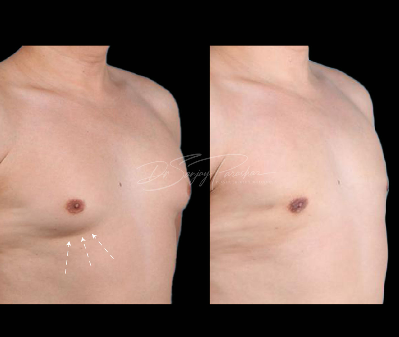 Gynecomastia Surgery In Dubai