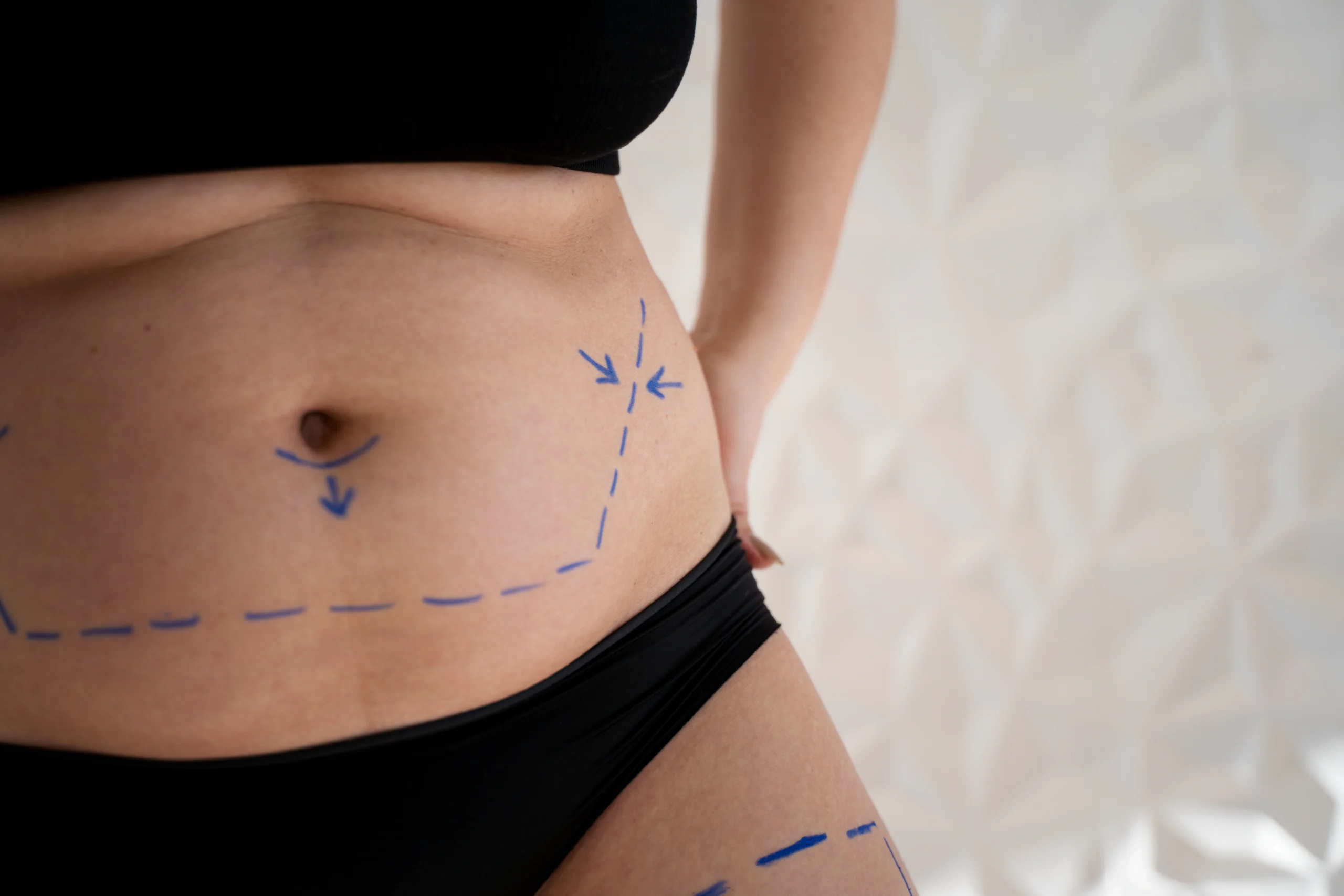 Patient planning full body rejuvenation by combining cosmetic procedures