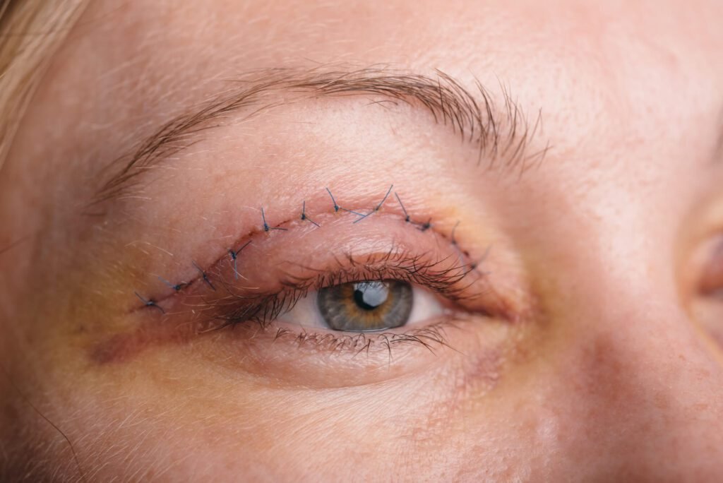 Upper Eyelid Surgery in Dubai: Blepharoplasty for a Refreshed Look