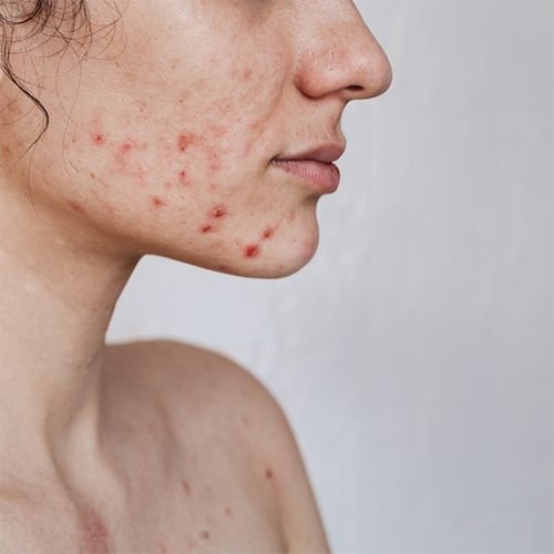 Scar treatment222