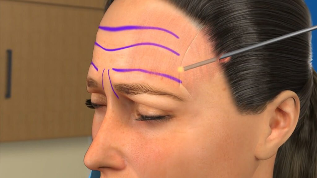 Forehead Reduction in Dubai: Hairline Lowering Surgery Explained