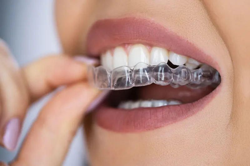 Invisalign in Dubai: Clear Aligners for Straightening Teeth Discreetly