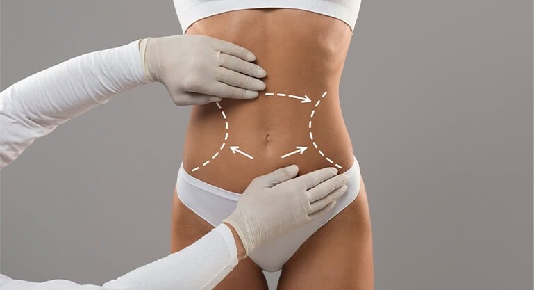 Diagram showing the incision length for Tummy tuck surgery