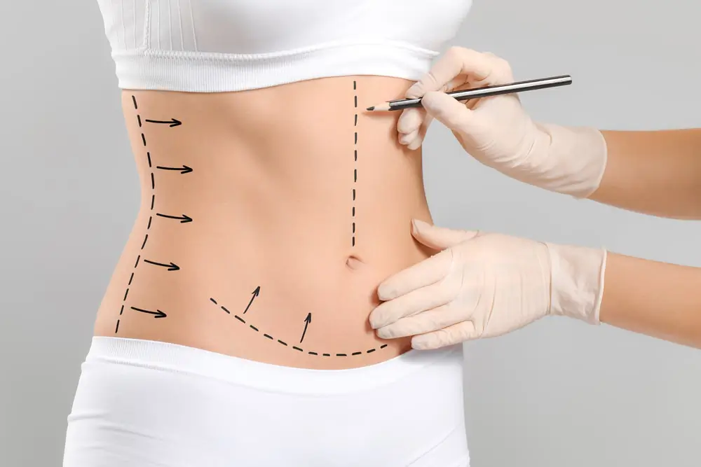 Tummy Tuck Surgery In Dubai