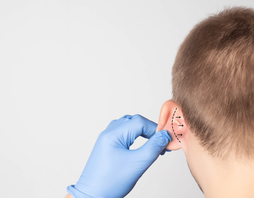 Ear Surgery in Dubai: Otoplasty for Adults and Children