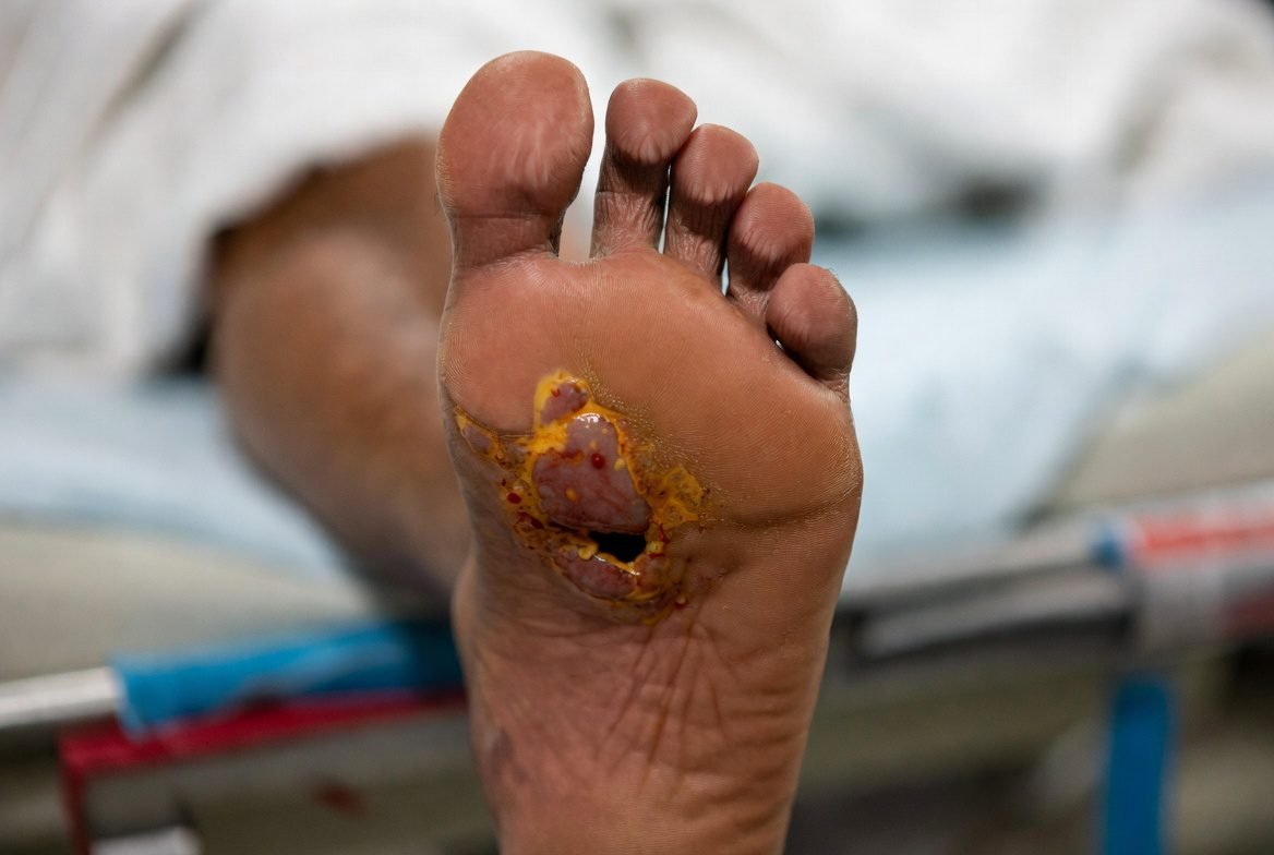 Wounds Treatment — Dr Sanjay Parashar Dubai
