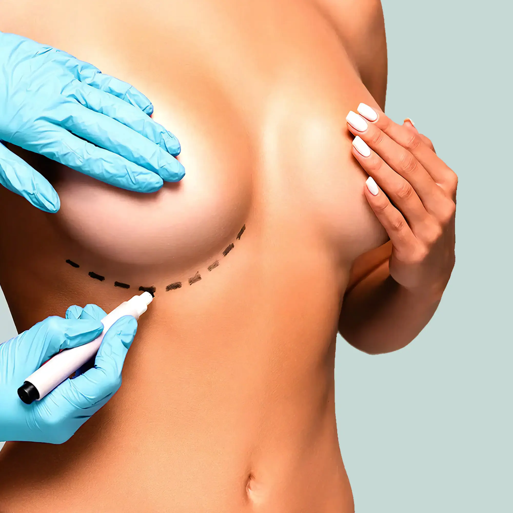 Breast-Lift